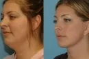 Tips for Reducing Double Chin