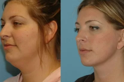 Tips for Reducing Double Chin