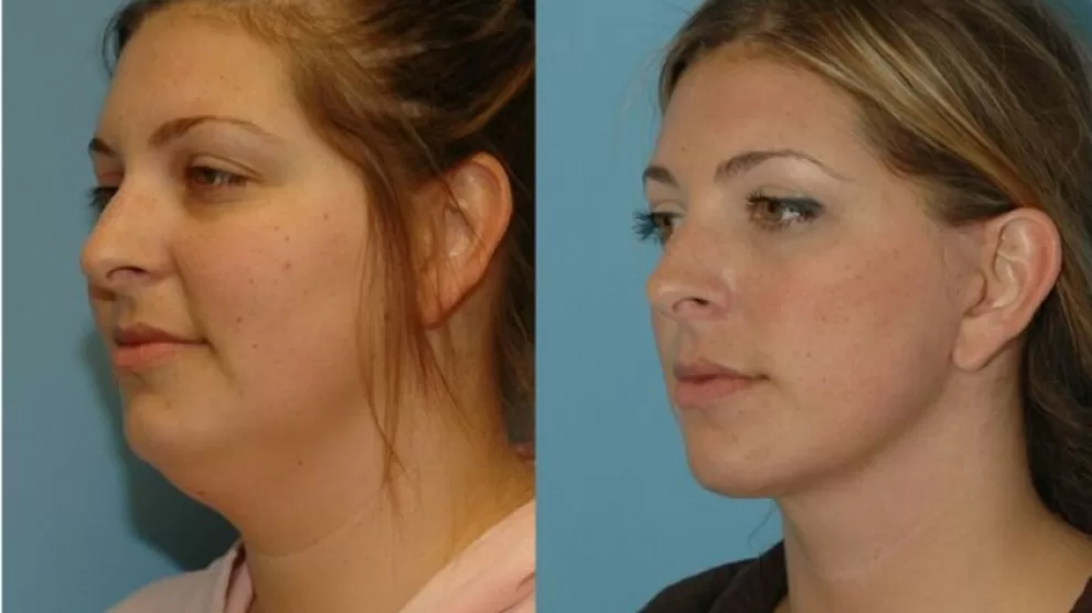 Tips for Reducing Double Chin
