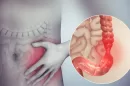 Colon Cancer