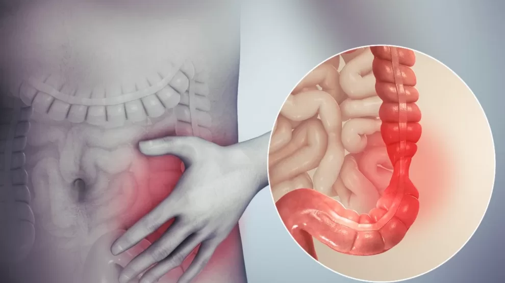 Colon Cancer