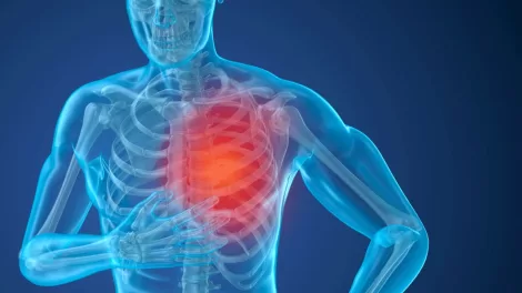 Pulmonary hypertension