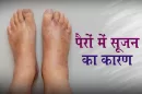 Causes of Swollen Feet