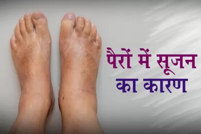 Causes of Swollen Feet