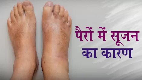 Causes of Swollen Feet