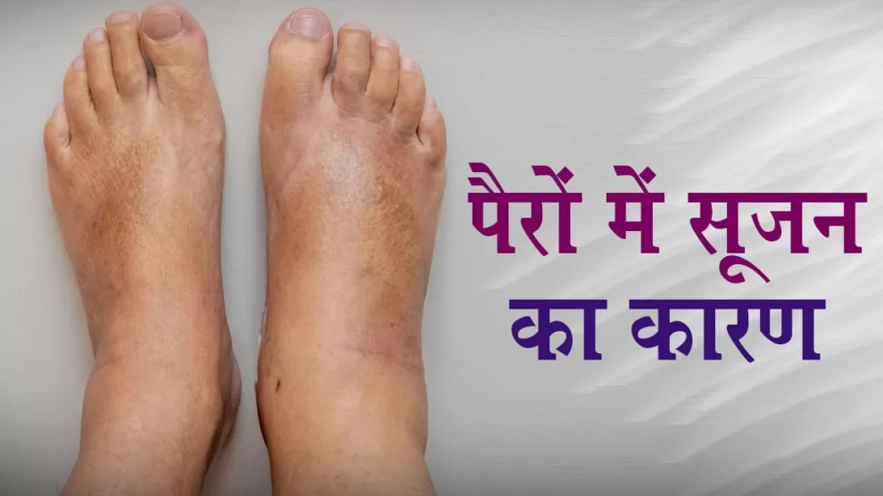 Causes of Swollen Feet